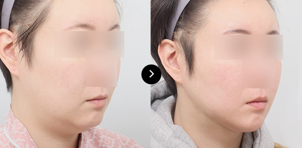 Lifting Benang Double-chin 이미지 2