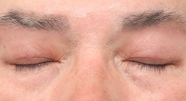 1 Bulan
Setelah Operasi