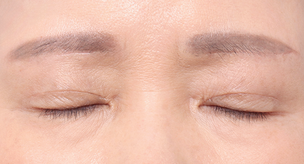 1 Bulan
Setelah Operasi