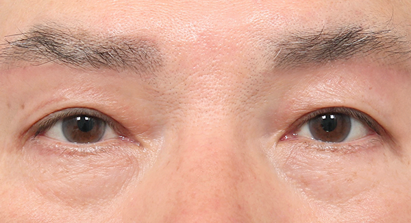 1 Bulan
Setelah Operasi