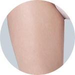 Liposuction result 4